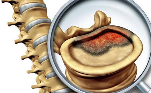 Asi es el sarcoma de Ewing, el tumor que tenia Elena Huelva : Trending de Colombia