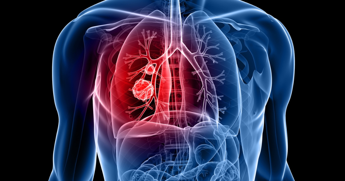 Un nuevo tratamiento aumenta la supervivencia en pacientes con cancer de pulmon : Trending de Colombia