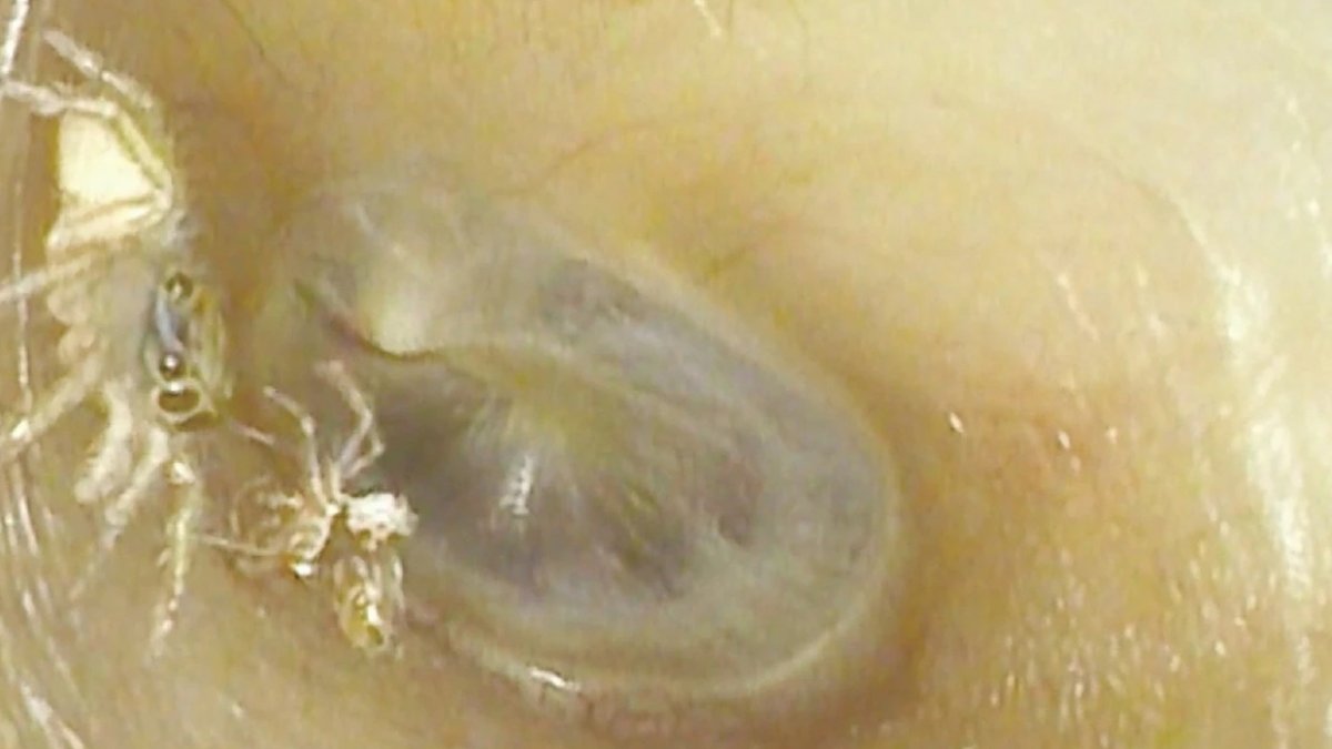 Escuchaba sonidos extraños: descubren que tenia una araña viviendo en su oido : Noticias de